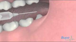 How a wisdom tooth is removed [upl. by Cacka]