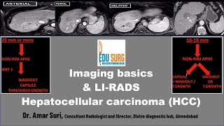 MRI liver lesions [upl. by Darbie]