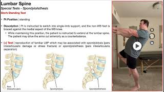 Stork Standing Test for Spondylolisthesis  Rationale amp Interpretation [upl. by March]