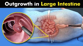 Colon Polypectomy  Removal Of Polyps From Large intestine UrduHindi [upl. by Decrem114]