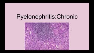 Chronic Pyelonephritis [upl. by Nodnol]