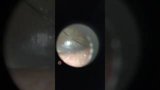 Small Ruptured Tympanic Membrane Right perforated ear drum [upl. by Kolosick]