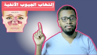 علاج الجيوب الأنفية الحادة والمزمنة  SINUSITIS [upl. by Eeruhs]