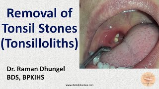 Oral cavity and Tonsillar Fossa [upl. by Hnil359]