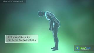 Kyphosis Symptoms [upl. by Yllaw]