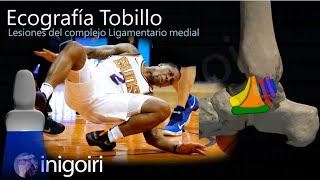 Patologia ligamentos mediales tobillo [upl. by Ynnaej663]