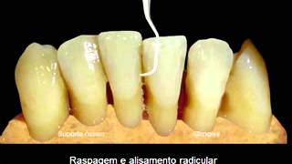 REPOSIÇÃO APICAL DO RETALHO [upl. by Llirred]