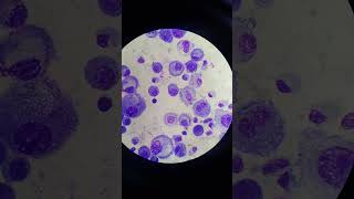 Mesothelial Cells in Pleural Fluid  Body Fluid  Fluids Giemsa Stain [upl. by Oloapnaig487]