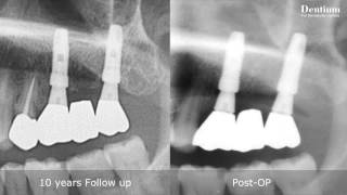 Implantium 10 years case [upl. by Ahsiemac]