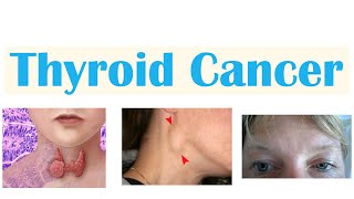 Thyroid Cancer Papillary Follicular Medullary amp Anaplastic  Symptoms Diagnosis Treatment [upl. by Light]