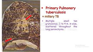 Miliary Tuberculosis [upl. by Sucramel]