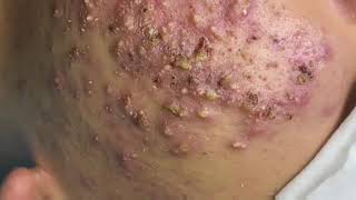 Satisfying and Relaxing with Squeezing Acne Acne Severe Hidden Acne Acne Treatment 19 [upl. by Socram]