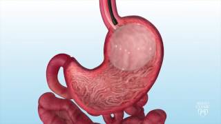 Gastric Balloon Surgery at Ramsay Health Care [upl. by Cioffred72]