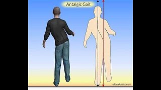 Antalgic Gait  Definition causes characteristics Disease association Diagnosis Treatment [upl. by Acinej]