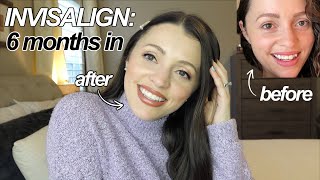 THE TRUTH ABOUT INVISALIGN  Before  After 6 months  FAQ Answered [upl. by Meilen]