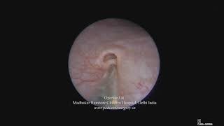 Endoscopic DextranomerHyaluronic Acid Injection Dexell® for vesicoureteral reflux VUR [upl. by Meadows]