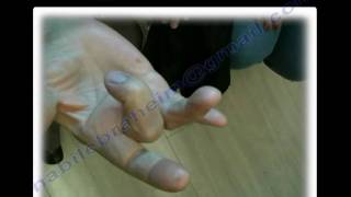 Trigger Finger  Thumb All you need to know [upl. by Saffier]