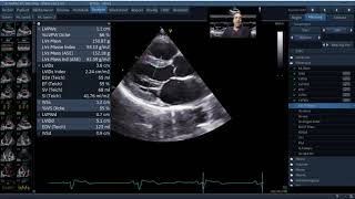 Standardisierte Echokardiographie  Normalbefund [upl. by Assenahs]