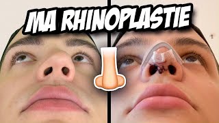 MA RHINOPLASTIE  Mon expérience prix avantaprès [upl. by Aisylla]