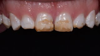 Fixing Brown Chipped TeethCosmetic Dentistry [upl. by Jermaine]