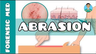 Abrasion  What are the causes of abrasion  What are types of abrasion [upl. by Av662]