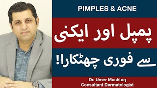 How To Remove Pimples Overnight  Acne Treatment  Pimple Khatam Karne Ka Tarika [upl. by Sewoll122]