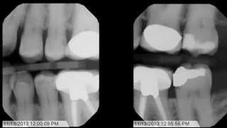 Tips and Tricks for Bitewing XRays [upl. by Konstantine316]