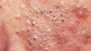 How To Get Rid Of Pimple Under Skin At Home ✦ Dr Laelia ✦ [upl. by Crescantia]