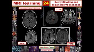 MRI learning 24 Demyelination and degenerative diseases [upl. by Stieglitz]