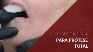 Moldagem Funcional para Prótese Total [upl. by Isadora900]