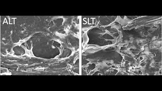 Selective Laser Trabeculoplasty Tips and Tricks Malik Y Kahook MD [upl. by Jasmina]