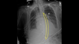 Intraaortic balloon pump IABP inflated seen in Computed Tomography CT [upl. by Amri]