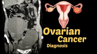 Ovarian Cancer diagnosis  CT SCAN [upl. by Gnoix]