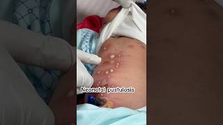 Neonatal pustulosis newborn day 5 skin infection ankur maitrika hospital jammu [upl. by Reiser82]