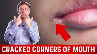 What Causes Cracked Corners of Mouth amp How to Get Rid of Angular Cheilitis – Dr Berg [upl. by Asir]