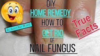 DIY Fingernail Fungus Treatment Home Remedy  Please read the description 101 [upl. by Eoj]