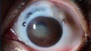 RHEUMATOID ARTHRITS amp EYE SCLERITIS [upl. by Chaddie]