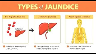 Jaundice  types causes symptoms newborn jaundice diet treatment [upl. by Anifur405]