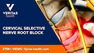 Cervical Selective Nerve Root Block [upl. by Ellehsram]