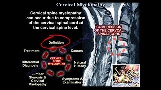 Cervical Myelopathy  Everything You Need To Know  Dr Nabil Ebraheim [upl. by Rhetta]