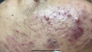 Blackheads Removal at Duyên An 0125 [upl. by Maya]