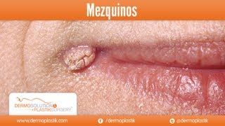 Dermoplastik  Mezquinos [upl. by Lienet]