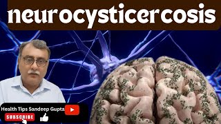 Neurocysticercosis नयूरो सिसटीसरकोसिस [upl. by Ertsevlis]