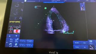 How to measure strain on the GE Vivid echo machines [upl. by Llenaej]