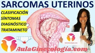 SARCOMAS UTERINOS TIPOS SÍNTOMAS DIAGNÓSTICO TRATAMIENETO  Ginecología y Obstetricia [upl. by Ettenahs]