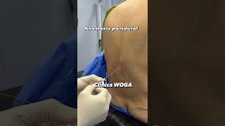 Anestesia en abdominoplastia con lipoescultura anestesiaperidural anestesia [upl. by Anrapa]