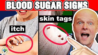 10 Alarming Signs Your Blood Sugar Is Too High [upl. by Blinni448]