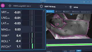 AlignRT Advance Breath Hold Overview [upl. by Llednyl]