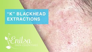 Blackheads Extractions “K’s” 8th Treatment Part 2 [upl. by Atenahs]