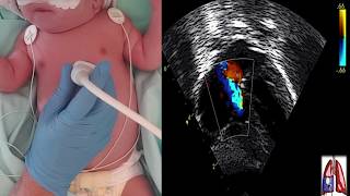 ECHOCARDIOGRAPHIC ASSESSMENT OF PULMONARY ARTERIAL HYPERTENSION IN THE NEWBORN [upl. by Anyak248]